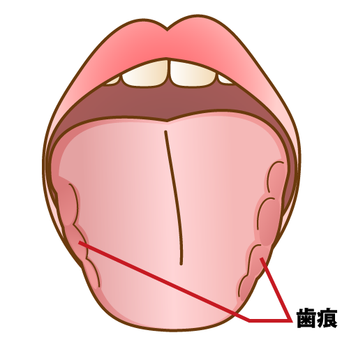 歯痕舌